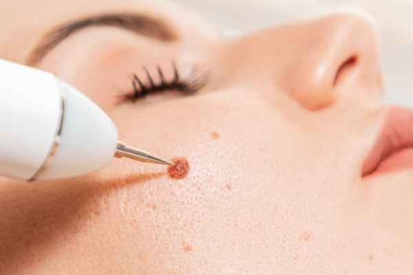 CryoPen: 5 Skin Concerns It May Be Used to Treat 3 What actually happens during a CryoPen treatment Almondsbury?