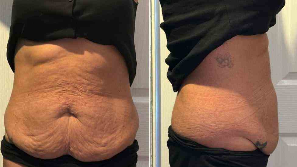 Lost the Weight but Not the Loose Skin? What You Should Know 1 Is It Definitely Loose Skin Almondsbury?